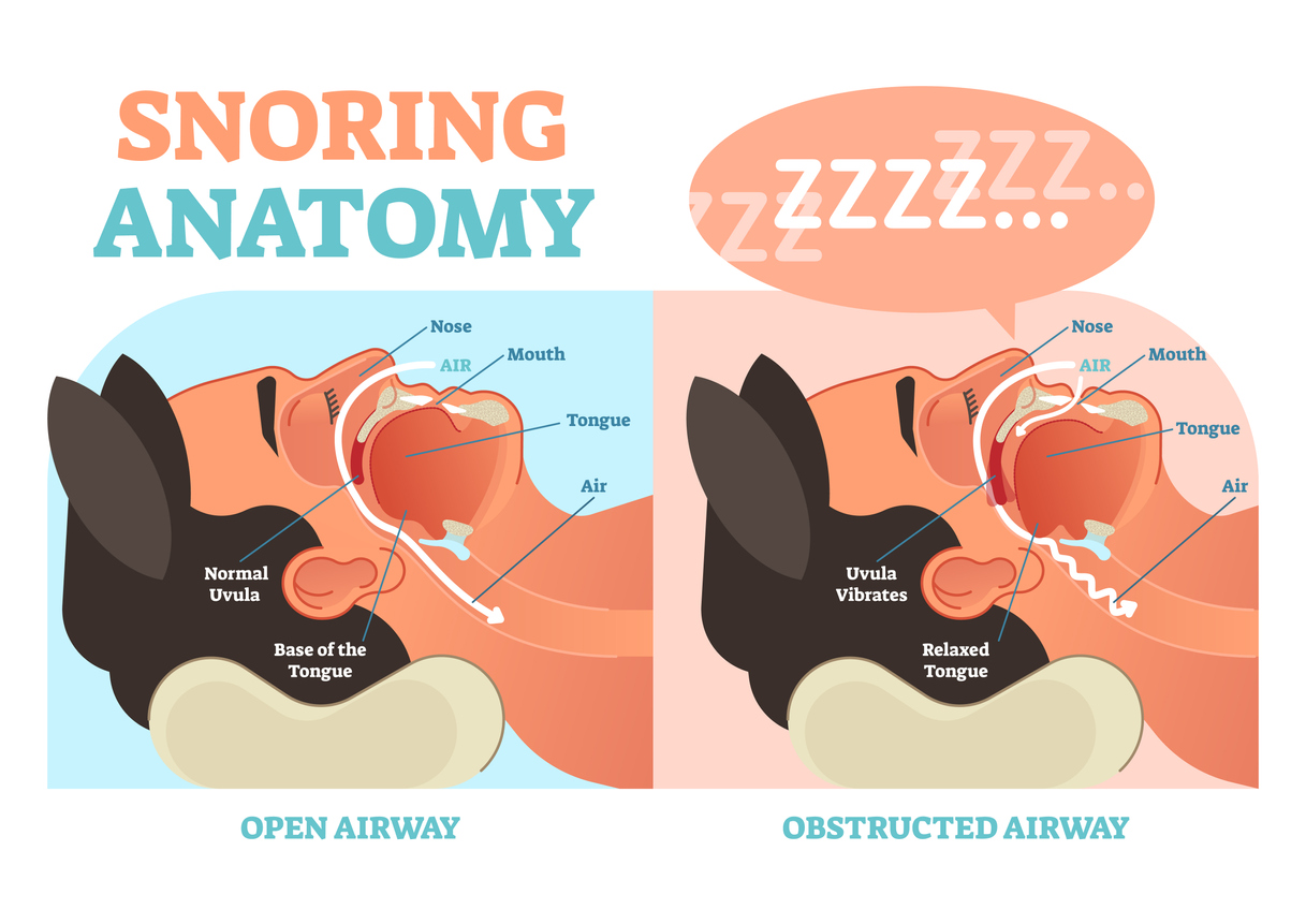 Put Snoring To Bed